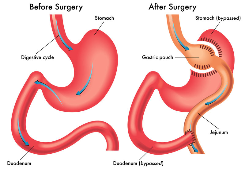 Gastric Sleeve