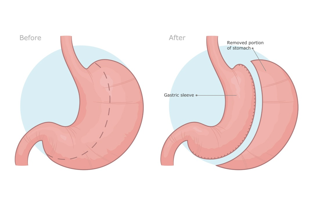 Gastric Sleeve